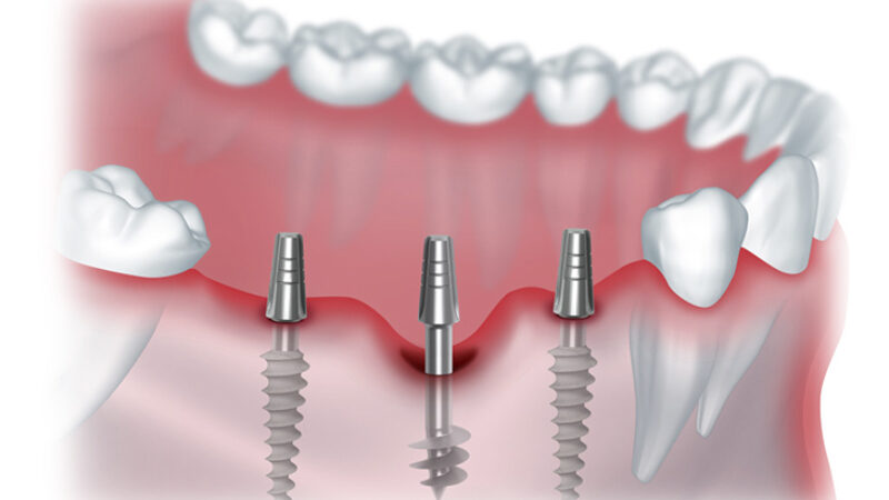 Ключевые преимущества протезирования зубов
