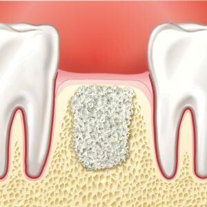 Остеопластика при имплантации зубов и ее особенности