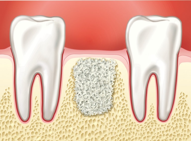 Остеопластика при имплантации зубов и ее особенности