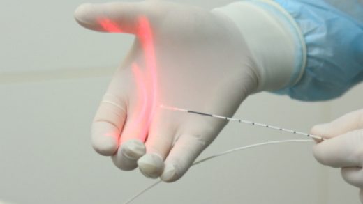 Сучасні технології в лазерному лікуванні варикозу: останні досягнення