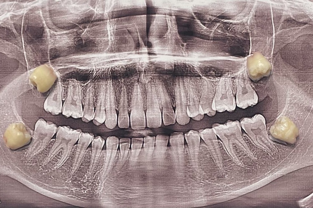 Всё, что вы хотели знать о удалении зубов мудрости
